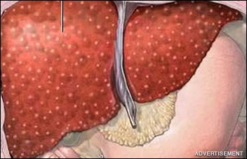 3 Signs You May Have A Fatty Liver